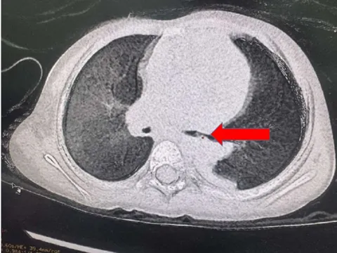 Bé gái 2 tuổi ho khó thở vì miếng thịt trong phế quản suốt 3 tháng