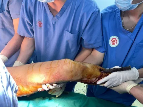 Cấp cứu thành công nam thanh niên bị tai nạn lao động nghiêm trọng