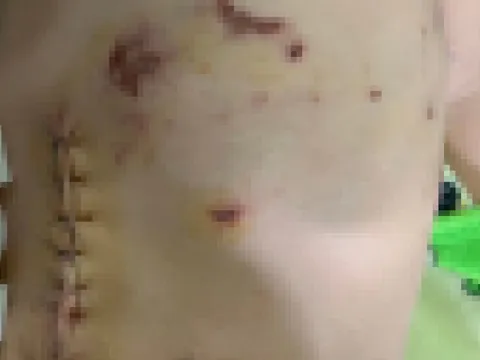 Chó nuôi cắn thủng bụng bé 4 tuổi ở An Giang