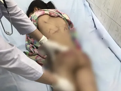 Điều tra vụ bé gái bị chi chít vết thương khi ở với cô họ