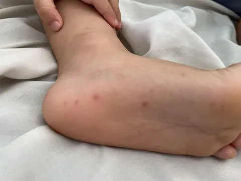 TPHCM: Xuất hiện chủng virus gây bệnh tay chân miệng nặng