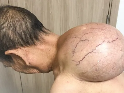 Phẫu thuật cắt bỏ thành công khối u 'khổng lồ' trên lưng cụ bà 95 tuổi