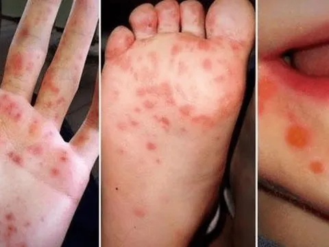 Gần 9.000 ca tay chân miệng, 3 ca tử vong, Bộ Y tế chỉ đạo tăng cường phòng chống