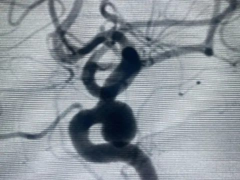 Gỡ 'bom nổ chậm' trong não, kịp thời cứu nữ bệnh nhân thoát cửa tử