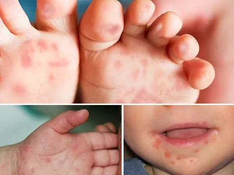 Các BV lớn rà soát nhân lực, thiết bị để tiếp nhận ca mắc tay chân miệng nặng