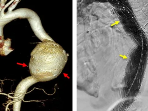 Cứu bệnh nhân nước ngoài bị vỡ túi phình động mạch chủ khổng lồ
