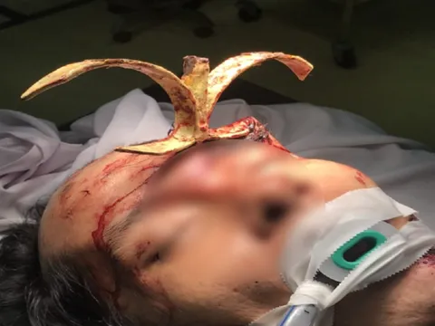 TPHCM: Người đàn ông bị sắt đâm xuyên trán, cắm thẳng vào hộp sọ