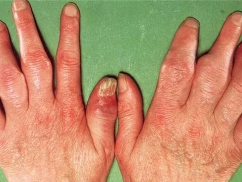 Đặc trị bệnh vảy nến bằng phương thuốc gia truyền