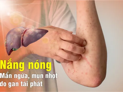 Nắng nóng – Mẩn ngứa, mụn nhọt do gan tái phát