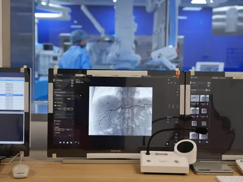 Nút mạch điều trị ung thư gan nhẹ nhàng, ít tác dụng phụ với phương pháp hạt ngậm hóa chất hiện đại