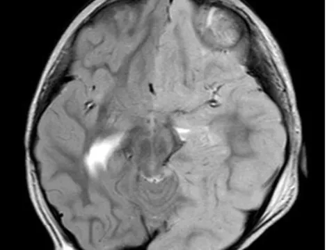 Liên tiếp phát hiện 2 trẻ bị viêm não cấp hiếm gặp
