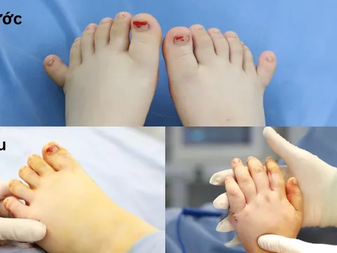 Em bé có 12 ngón tay, 12 ngón chân cực kỳ hiếm gặp