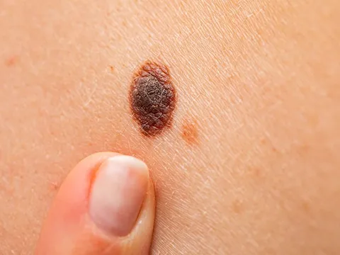 Nốt ruồi có dấu hiệu này nên đi khám ung thư