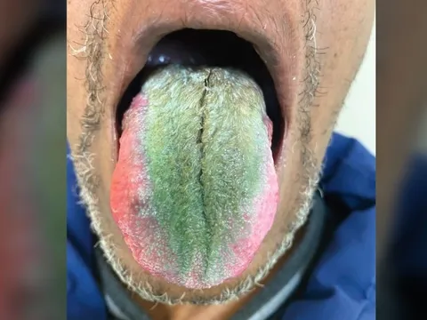 Kỳ lạ người đàn ông có lông mọc dày và xanh lè trên lưỡi