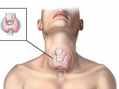 Dấu hiệu bất thường cảnh báo nguy cơ bị ung thư tuyến giáp, tuyệt đối không được bỏ qua