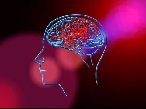 Tìm ra phương pháp mới có thể giảm nguy cơ tái phát đột quỵ