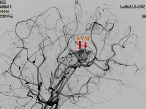 Bé gái 12 tuổi bị đột quỵ