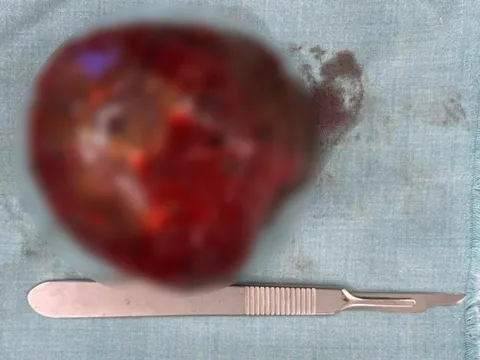 Bé sơ sinh mang bướu máu gan khổng lồ