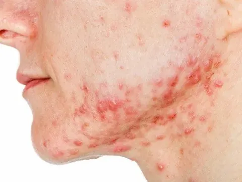 Sắp có vắc xin ngừa mụn trứng cá