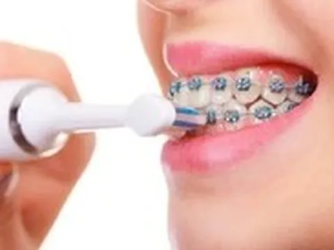 Ăn gì, vệ sinh răng thế nào khi đang niềng răng?