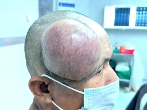 Phẫu thuật thành công khối u to như cái chén ở đầu bệnh nhân