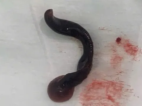 Con đỉa dài 4cm sống trong mũi người đàn ông