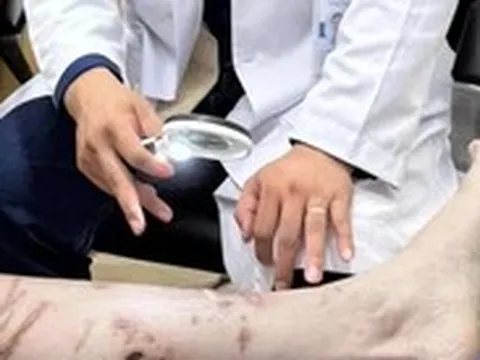 Bội nhiễm, sẹo phì đại vì bị sứa bám khi đang tắm biển