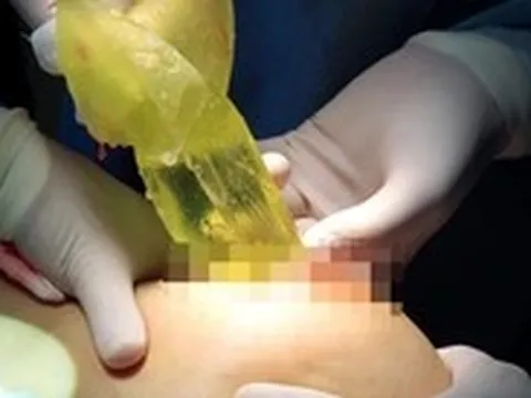 Bộ Y tế vào cuộc vụ bệnh nhân tử vong sau khi nâng ngực và hút mỡ tại TP.HCM