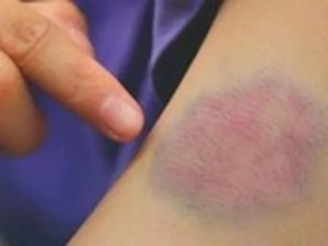 Bỗng dưng xuất hiện vết bầm tím, có thể là dấu hiệu rối loạn tiểu cầu