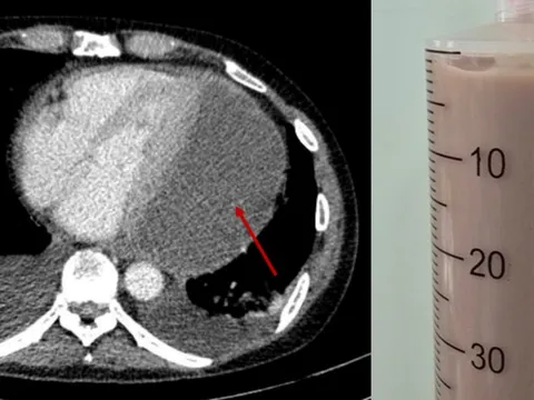 Tưởng bệnh vặt không ngờ suýt chết vì bệnh hiếm gặp