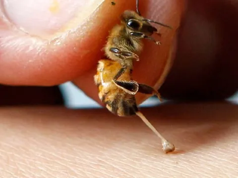 Dùng ong đốt để điều trị ung thư, người phụ nữ phải cắt bỏ cả hai bên ngực