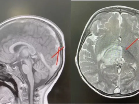 Bé trai hơn 2 tuổi đột quỵ vì bệnh lý hiếm gặp