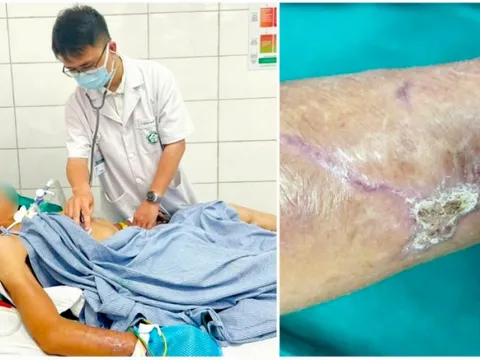 Cứng hàm, suy hô hấp vì vết xước nhỏ, cảnh báo 'đặc biệt' từ hai ca uốn ván nặng