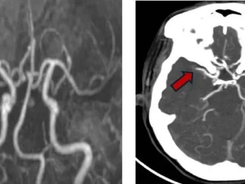 Người phụ nữ liên tiếp bị 2 cơn đột quỵ