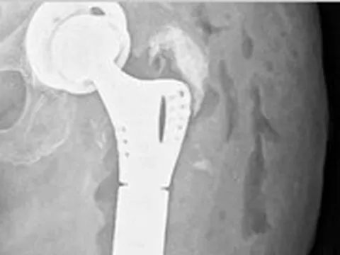 Lần đầu tiên tại miền Trung: Bệnh nhân được thay khớp háng và xương đùi nhân tạo