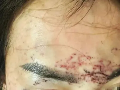 Vụ 'tố' bị bắt giữ, đánh đập, xăm mặt vì ghen: Khởi tố 2 người phụ nữ