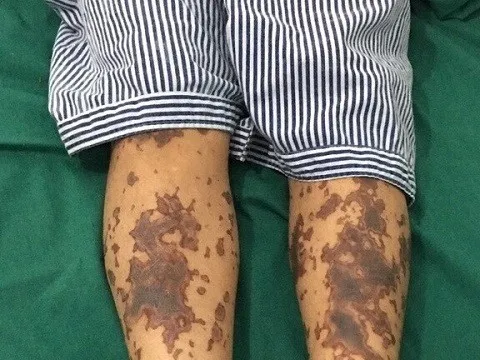 Huế: Xử lý khẩn khu vực có ca bệnh liên cầu khuẩn đầu tiên trong năm