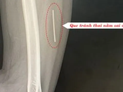 Đau cánh tay không ngờ que cấy tránh thai 'đi lạc' vào cơ bắp