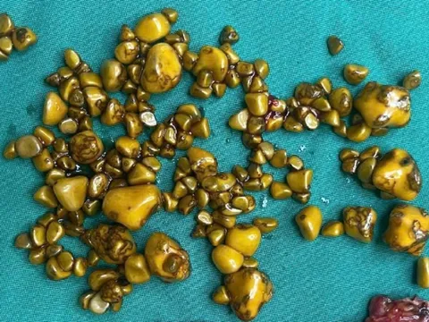 Người phụ nữ 'giấu cả trăm cục vàng' trong... túi mật