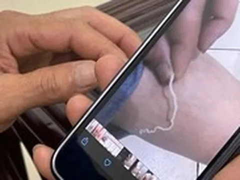 Rùng mình phát hiện giun rồng dài 70cm trong chân