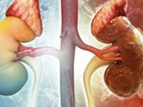 18 tuổi đã bị hỏng thận vì thói quen ăn uống