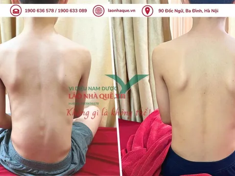 Phương pháp 'Khai thông cột sống' hỗ trợ điều trị đau do thoái hóa khớp tại Lão Nhà Quê