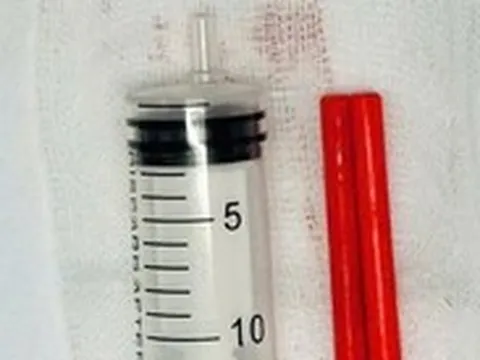 Bị hai chiếc đũa dài đâm vào mũi phải trong một lần uống say