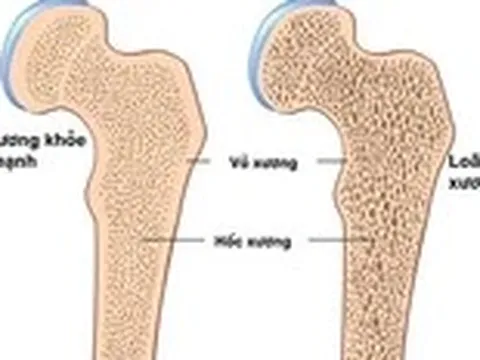 Làm gì để phòng ngừa bệnh loãng xương?