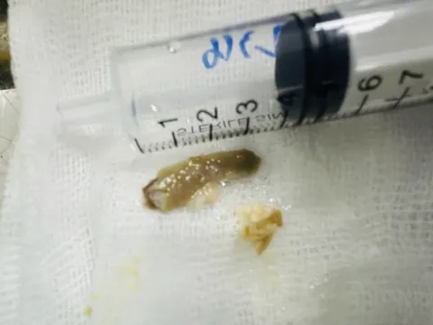 Gắp thành công đoạn xương gà dài nằm trong thực quản bé trai 12 tuổi