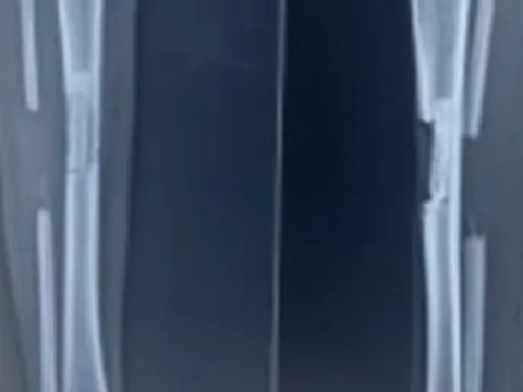 Cô gái chụp X-quang bất ngờ thấy mất xương chân