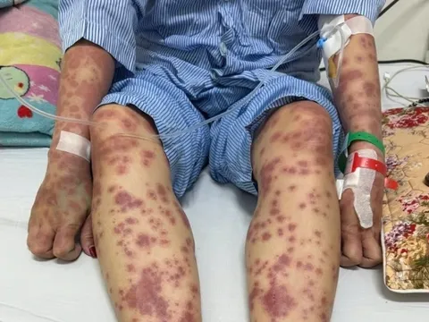 Suýt mất mạng vì 'thuốc giảm cân, collagen thải độc'