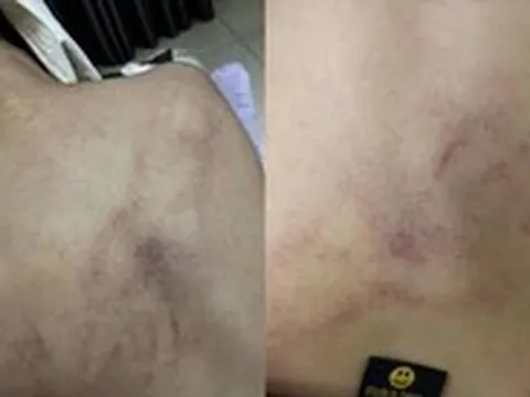 Gia đình tố cô giáo mầm non đánh, kéo lê, ném bé gái 4 tuổi vào tường