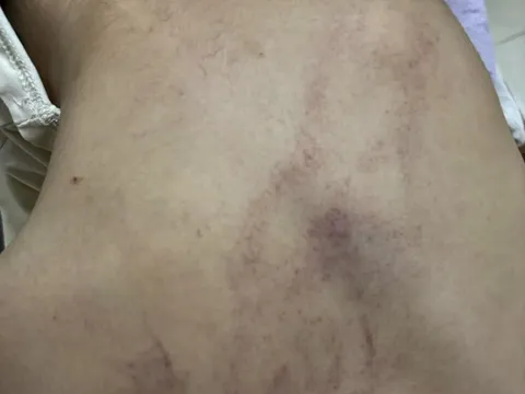 Bé mẫu giáo bị đánh tím lưng, clip từ camera khiến phụ huynh bàng hoàng