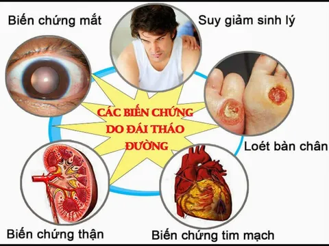 Biến chứng kép tim mạch – võng mạc ở bệnh nhân tiểu đường: Có thể ngăn chặn từ sớm